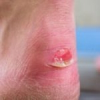 New Shoes May Cause Blisters