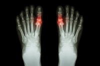 Symptoms of Gout