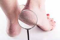 What Causes Cracked Heels?