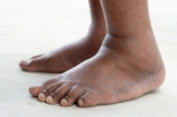 Causes and Dangers of Swollen Feet