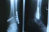 How an Ankle Fracture Can Disrupt Life