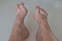 Foot Pain From High Arches