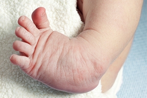 Facts About Clubfoot