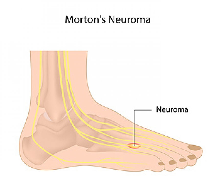 Understanding Mortons Neuroma